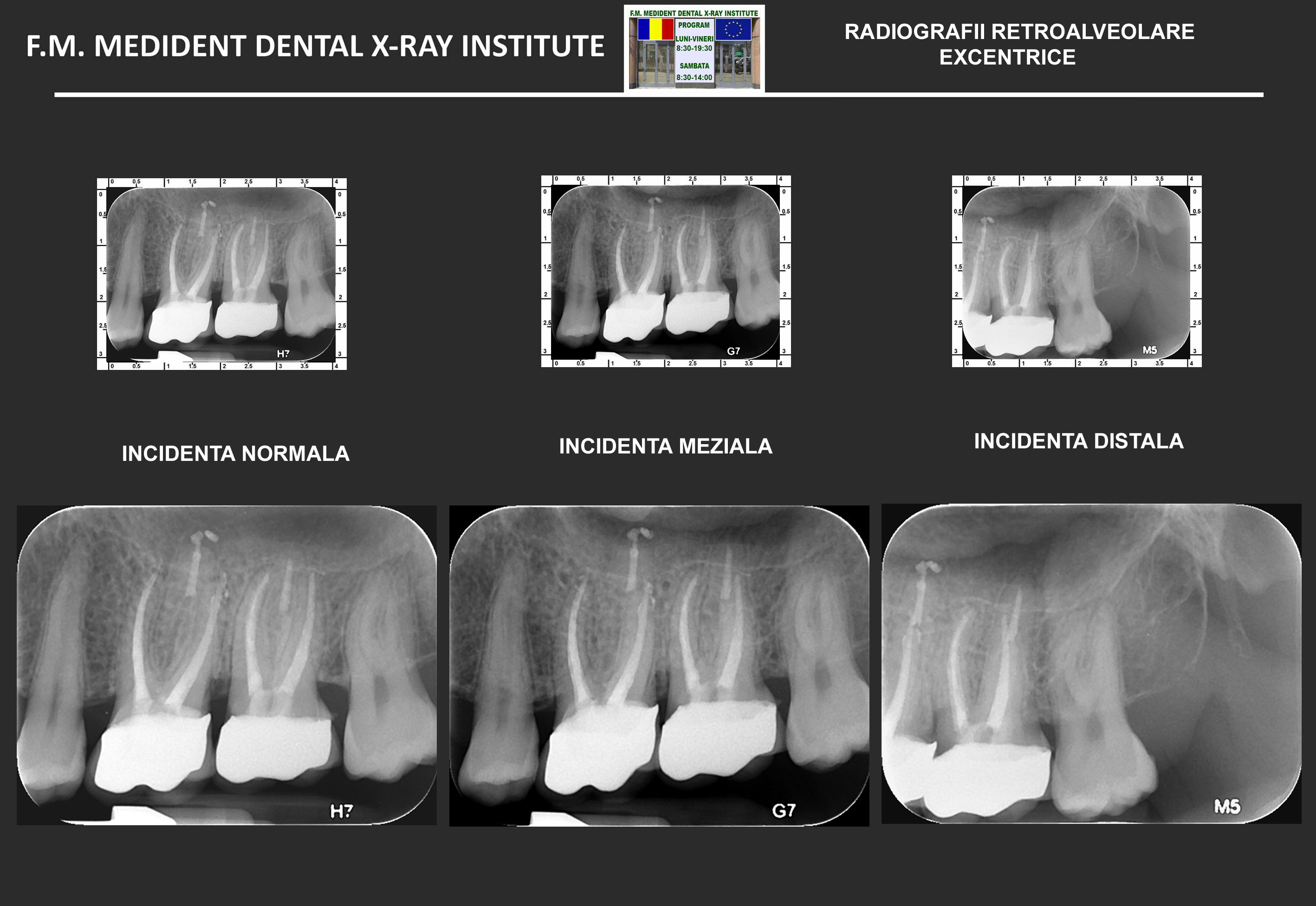 Eccentric periapical  X-Ray